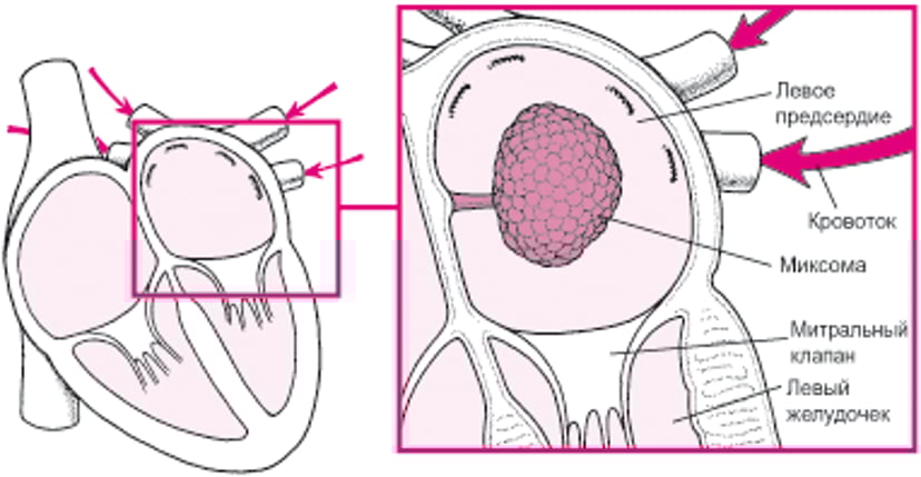 Как миксома может блокировать кровоток в сердце