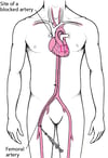 Understanding Percutaneous Coronary Intervention (PCI)