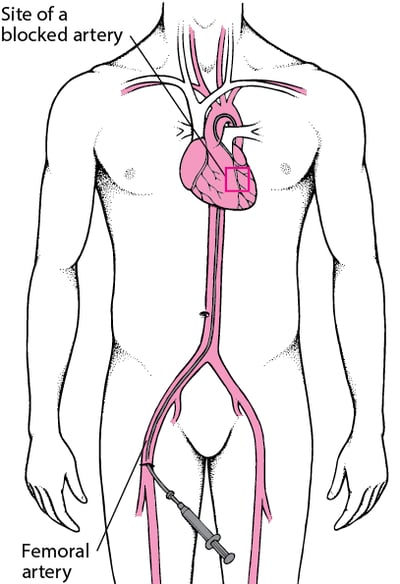 Understanding Percutaneous Coronary Intervention (PCI)
