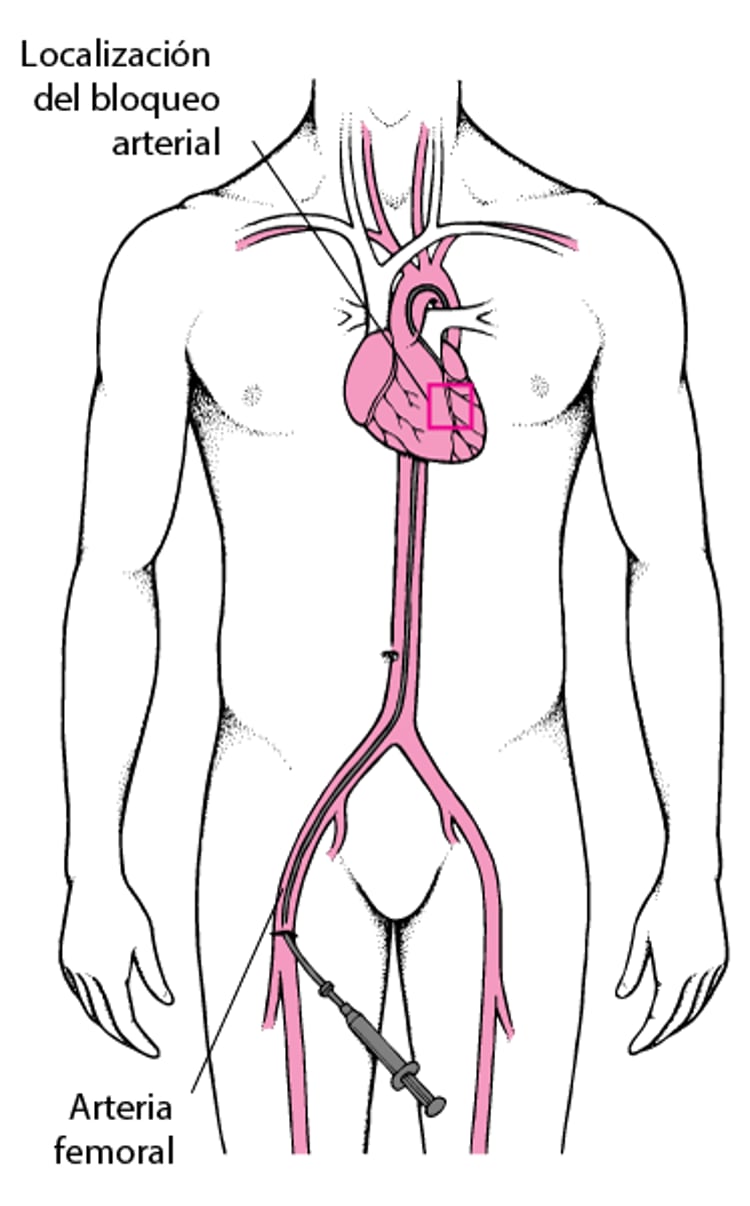 Qué es la intervención coronaria percutánea