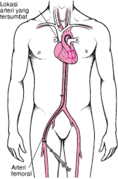 Memahami Intervensi Koroner Perkutan (PCI)