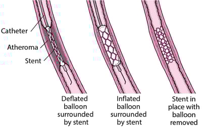 Understanding Percutaneous Coronary Intervention (PCI)