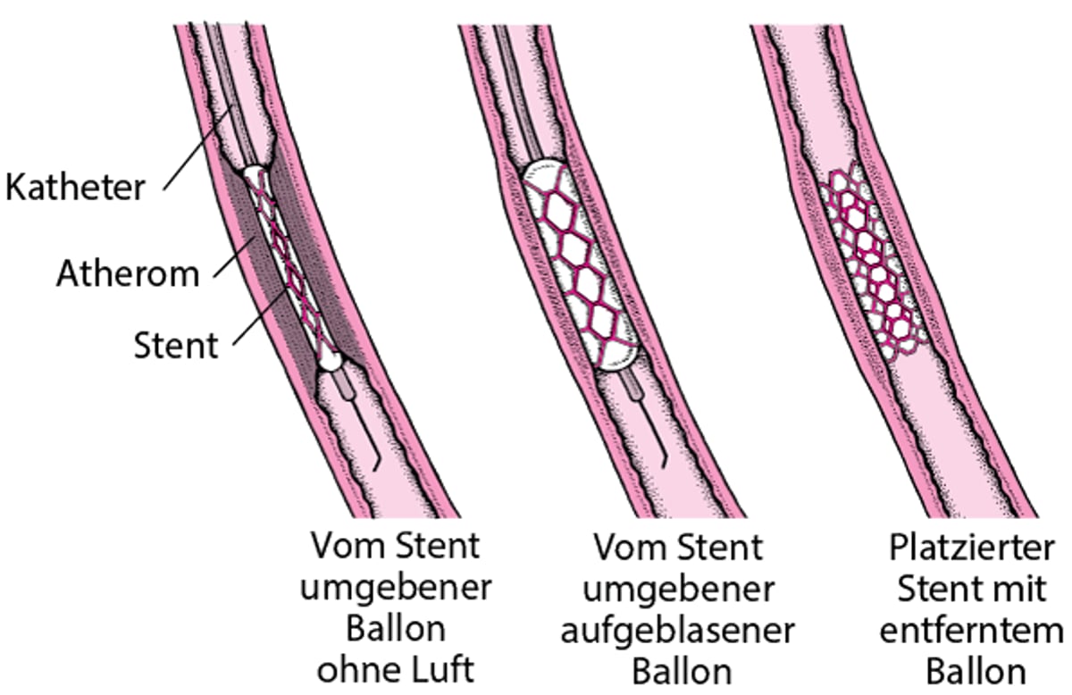 Veranschaulichung einer perkutanen Koronarintervention (PCI)