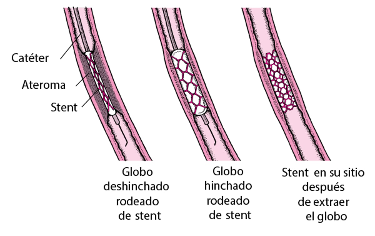 Qué es la intervención coronaria percutánea