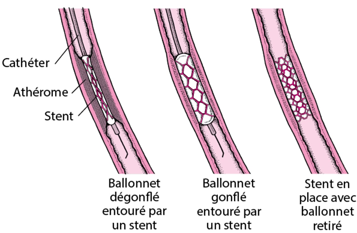 Comprendre l’intervention coronaire percutanée (ICP)