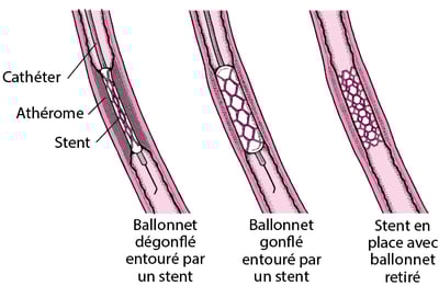 Comprendre l’intervention coronaire percutanée (ICP)