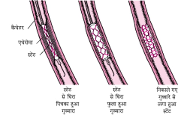 पर्क्यूटेनियस करोनरी इंटरवेंशन (PCI) को समझना