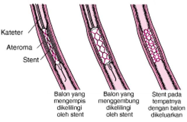 Memahami Intervensi Koroner Perkutan (PCI)