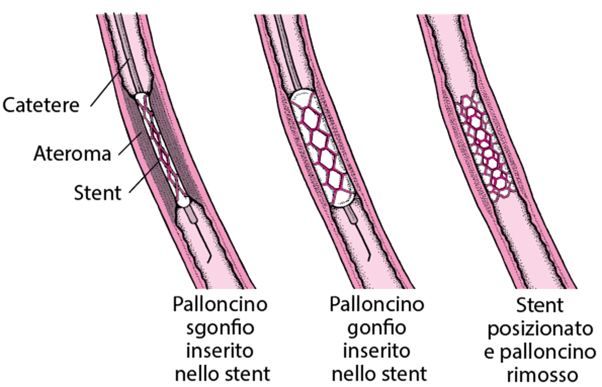 Capire l’intervento coronarico percutaneo (ICP)