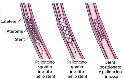 Capire l’intervento coronarico percutaneo (ICP)