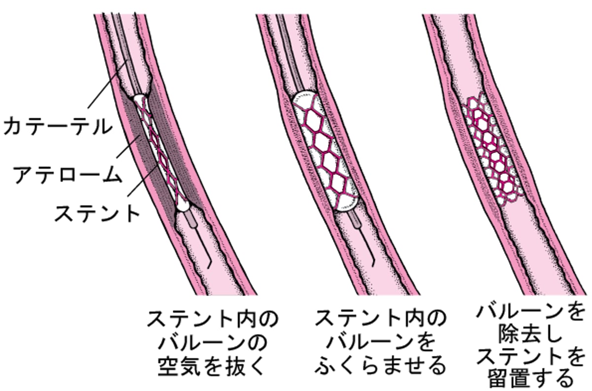 経皮的冠動脈インターベンション（PCI）について理解する