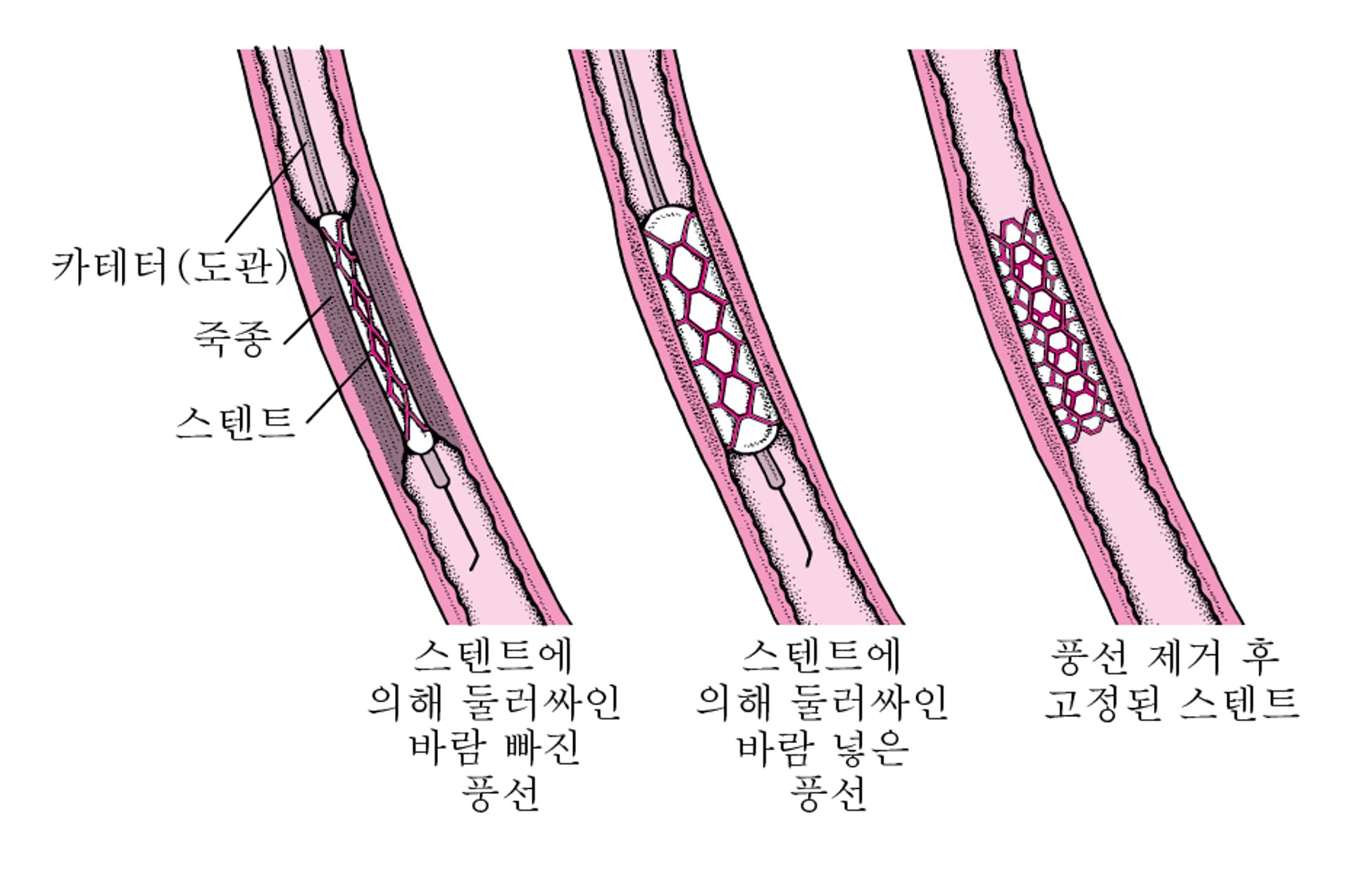 경피 관상동맥 중재술(PCI)이란