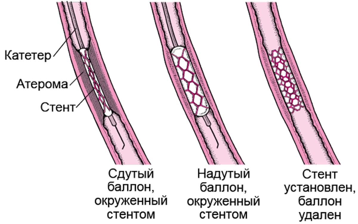 Объяснение процедуры чрескожного коронарного вмешательства (ЧКВ)