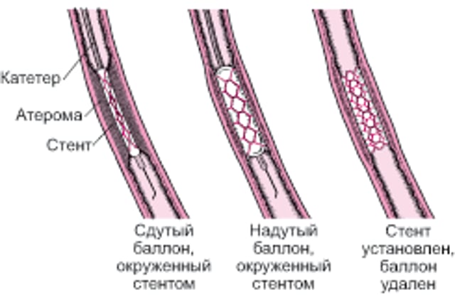 Объяснение процедуры чрескожного коронарного вмешательства (ЧКВ)