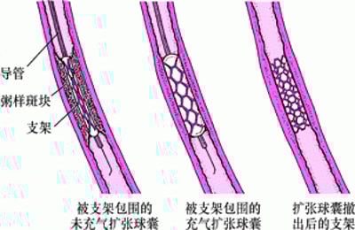 什么是经皮冠状动脉介入治疗 (PCI)