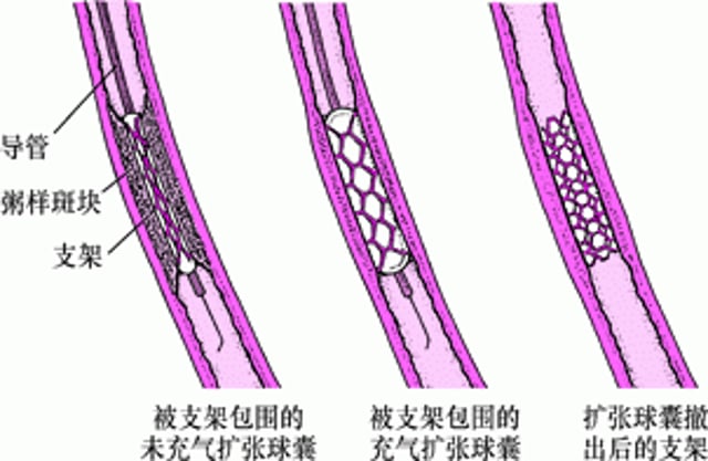 什么是经皮冠状动脉介入治疗 (PCI)