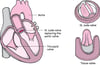 Replacing a Heart Valve