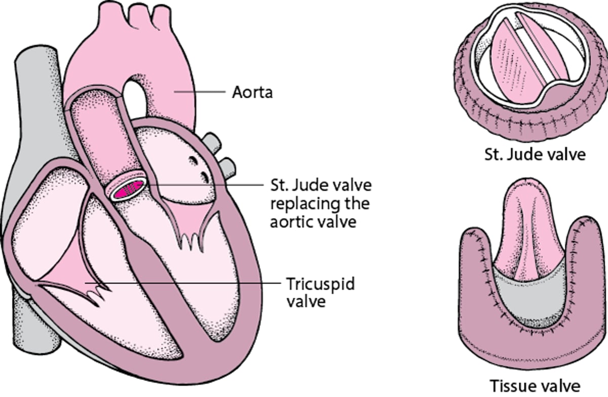 Replacing a Heart Valve