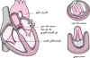 استبدال صمام قلبي