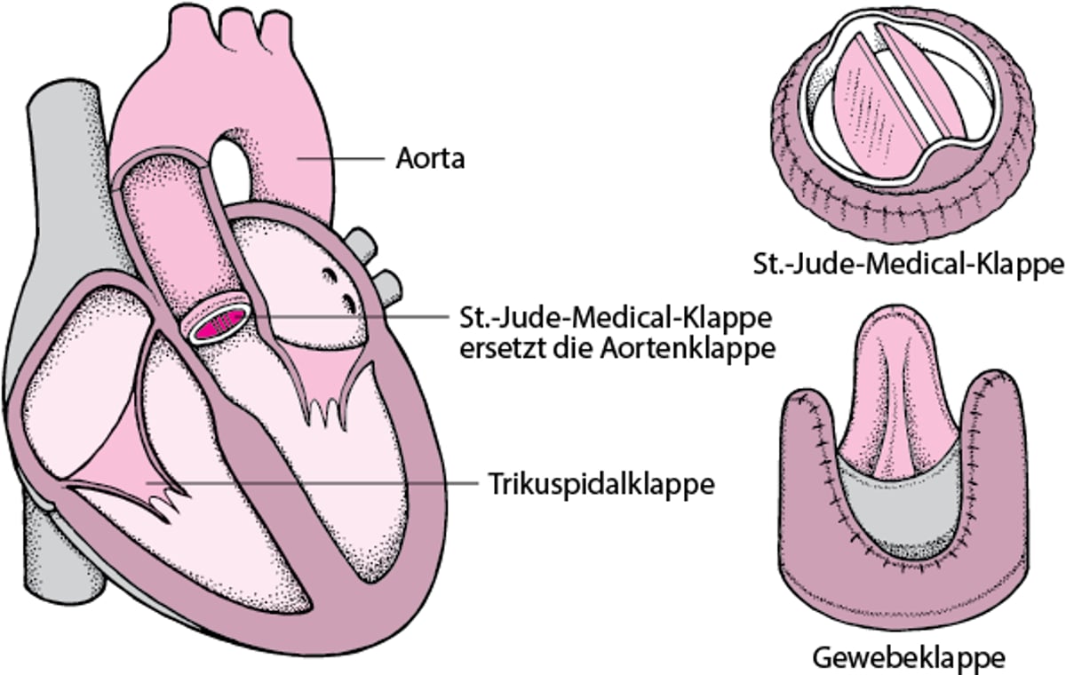 Ersatz einer Herzklappe