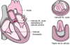 Sustitución de una válvula del corazón