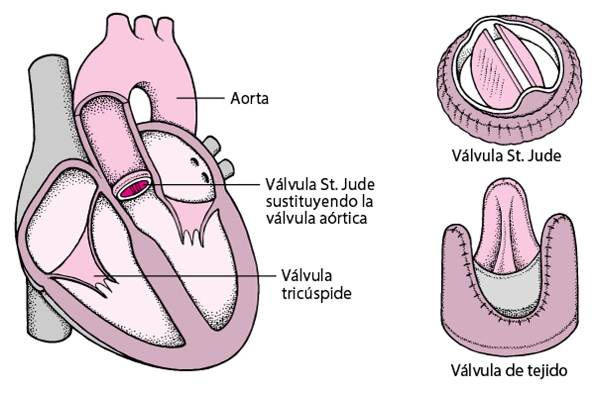 Sustitución de una válvula del corazón