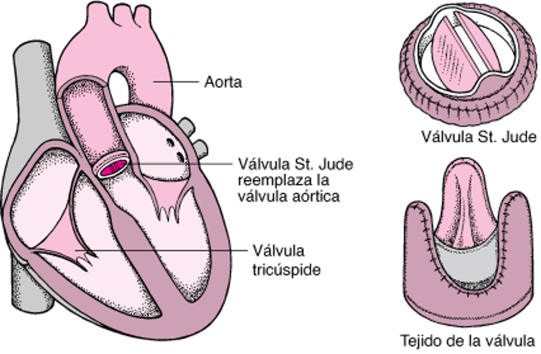 Sustitución de una válvula del corazón