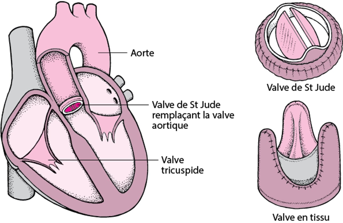 Remplacement d’une valvule cardiaque
