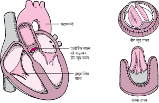 हृदय वाल्व को बदलना