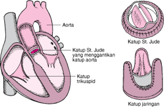 Mengganti Katup Jantung