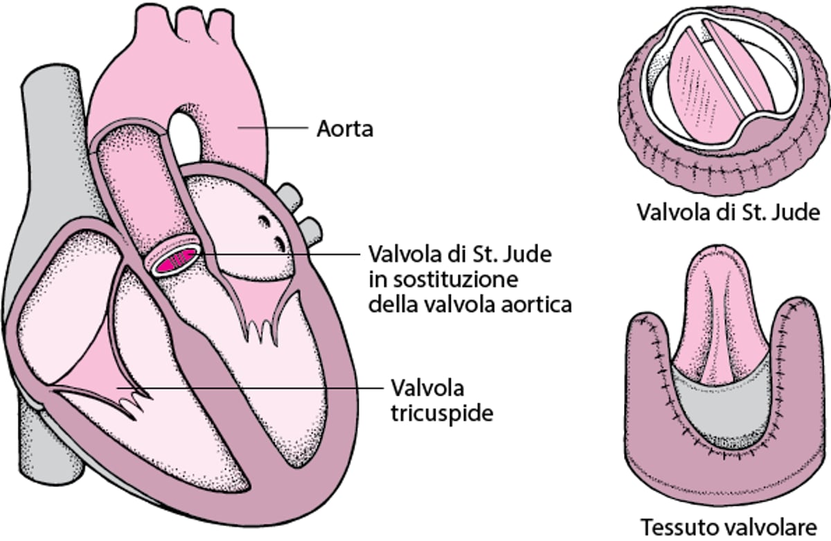 Sostituzione di una valvola cardiaca