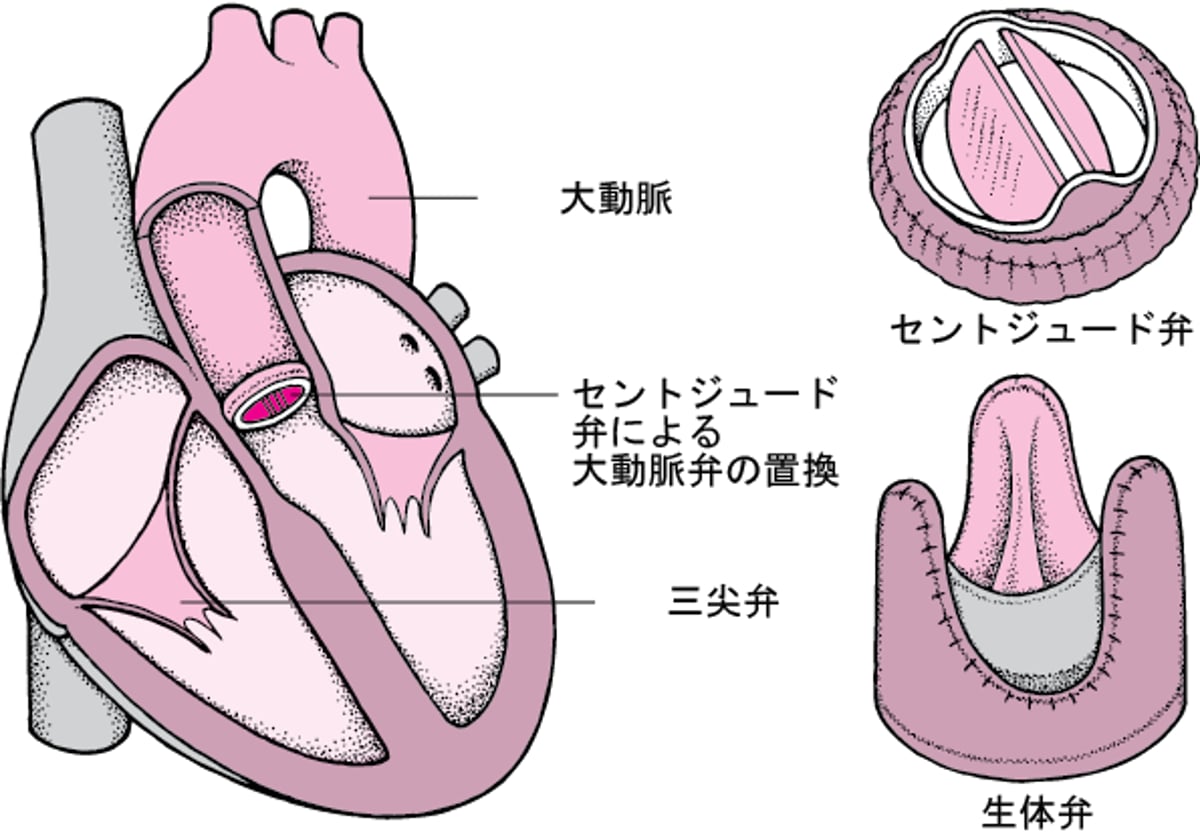心臓弁の置換手術