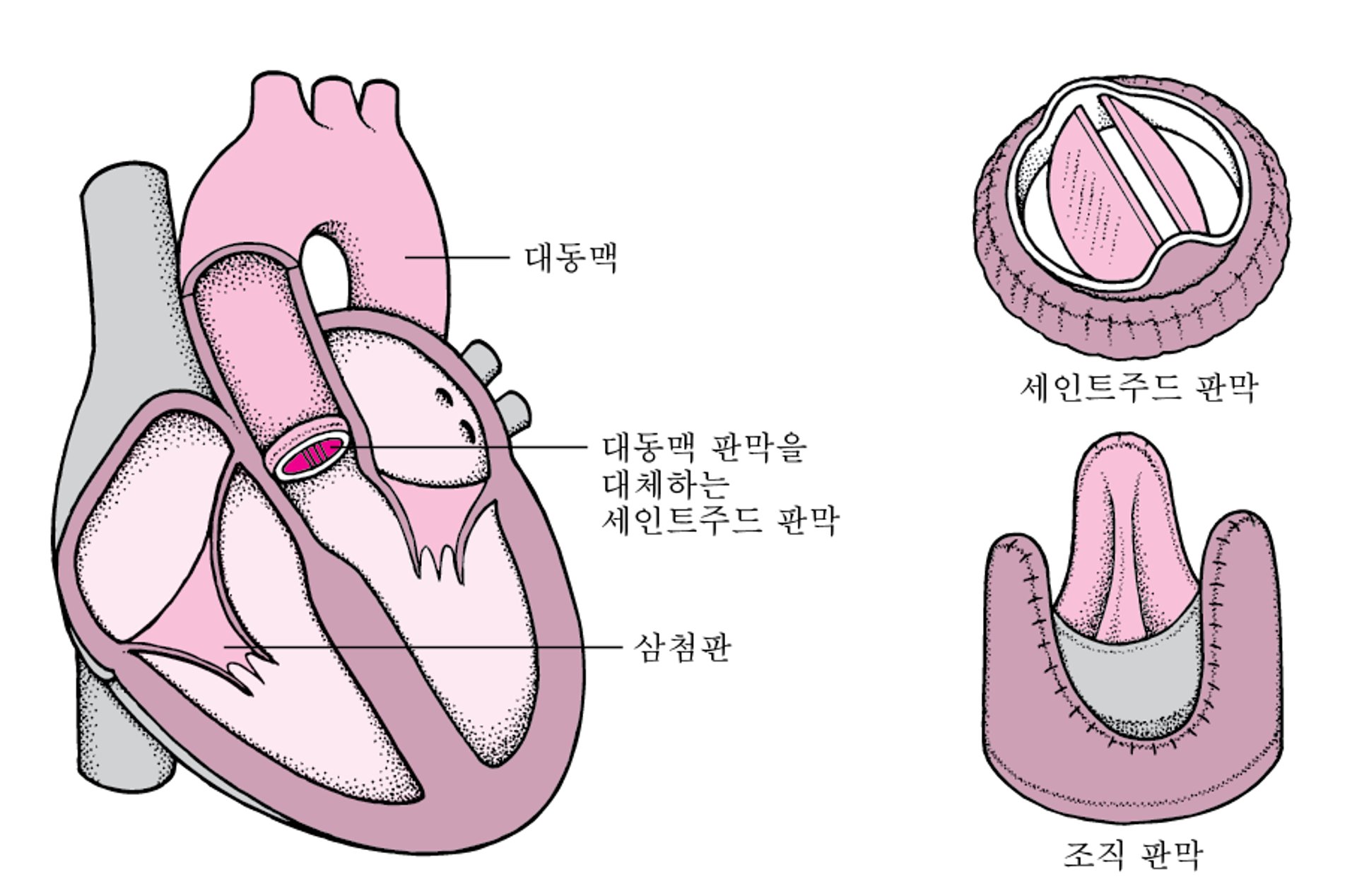 심장 판막 대치