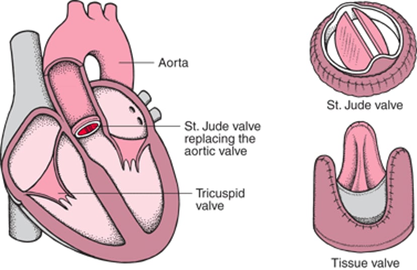 Substituindo uma válvula cardíaca