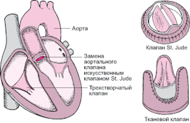 Замена сердечного клапана
