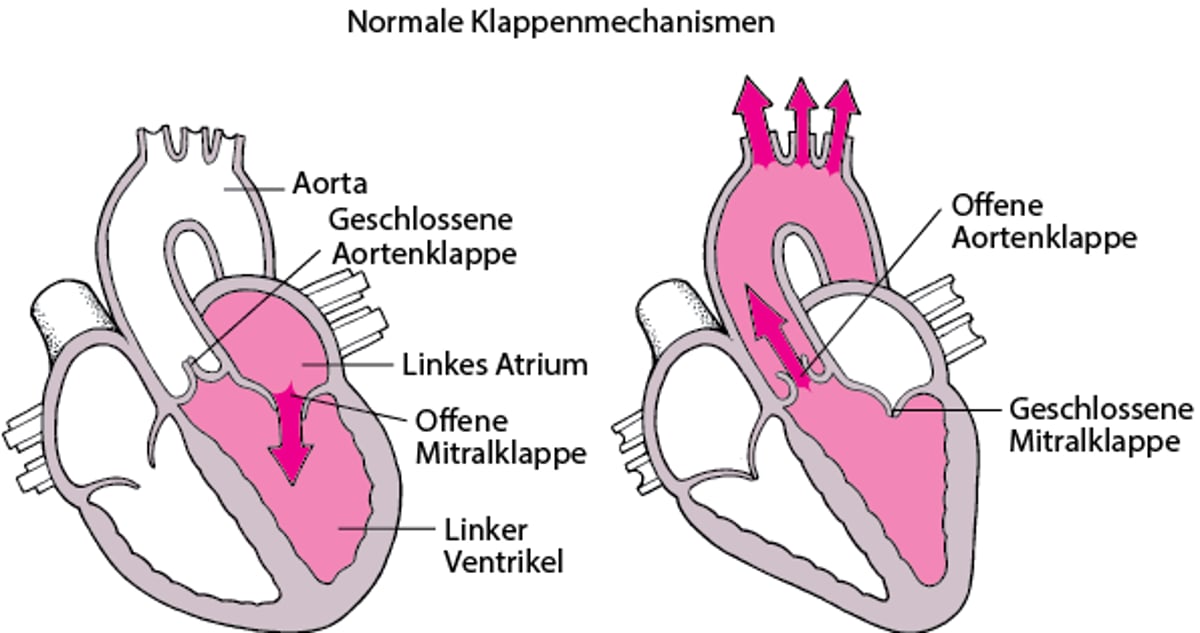 Stenose und Regurgitation