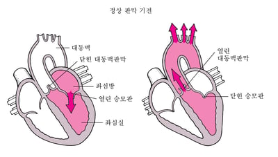 협착 및 역류란