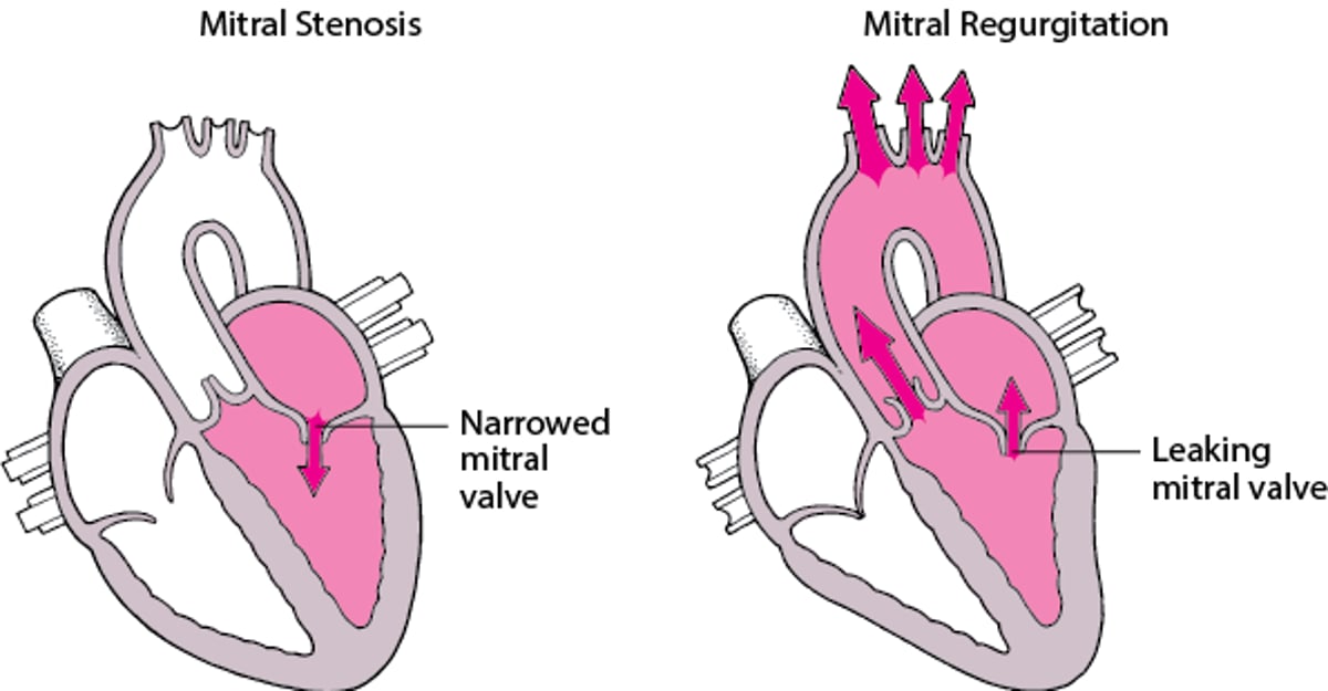 Understanding Stenosis and Regurgitation