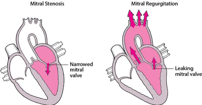 Understanding Stenosis and Regurgitation