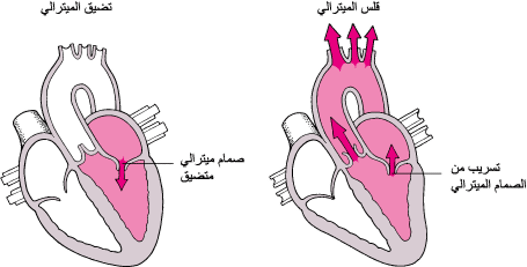 فهم التضيق والارتجاع