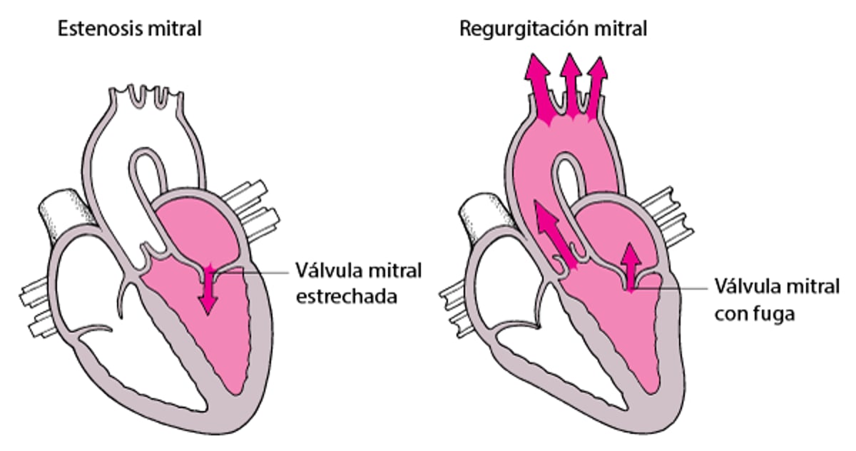 Qué son la estenosis y la regurgitación