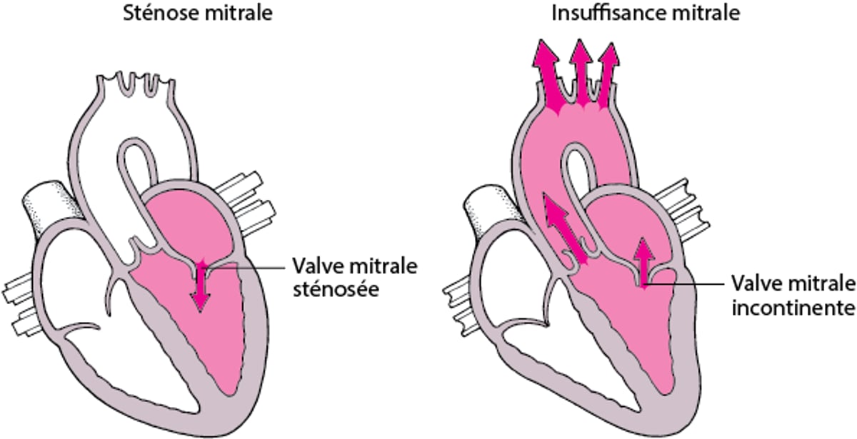 Comprendre la sténose et la régurgitation