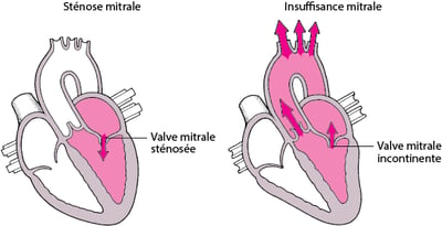 Comprendre la sténose et la régurgitation