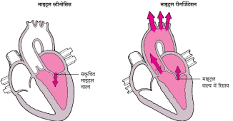 स्टीनोसिस और रीगर्जिटेशन को समझना