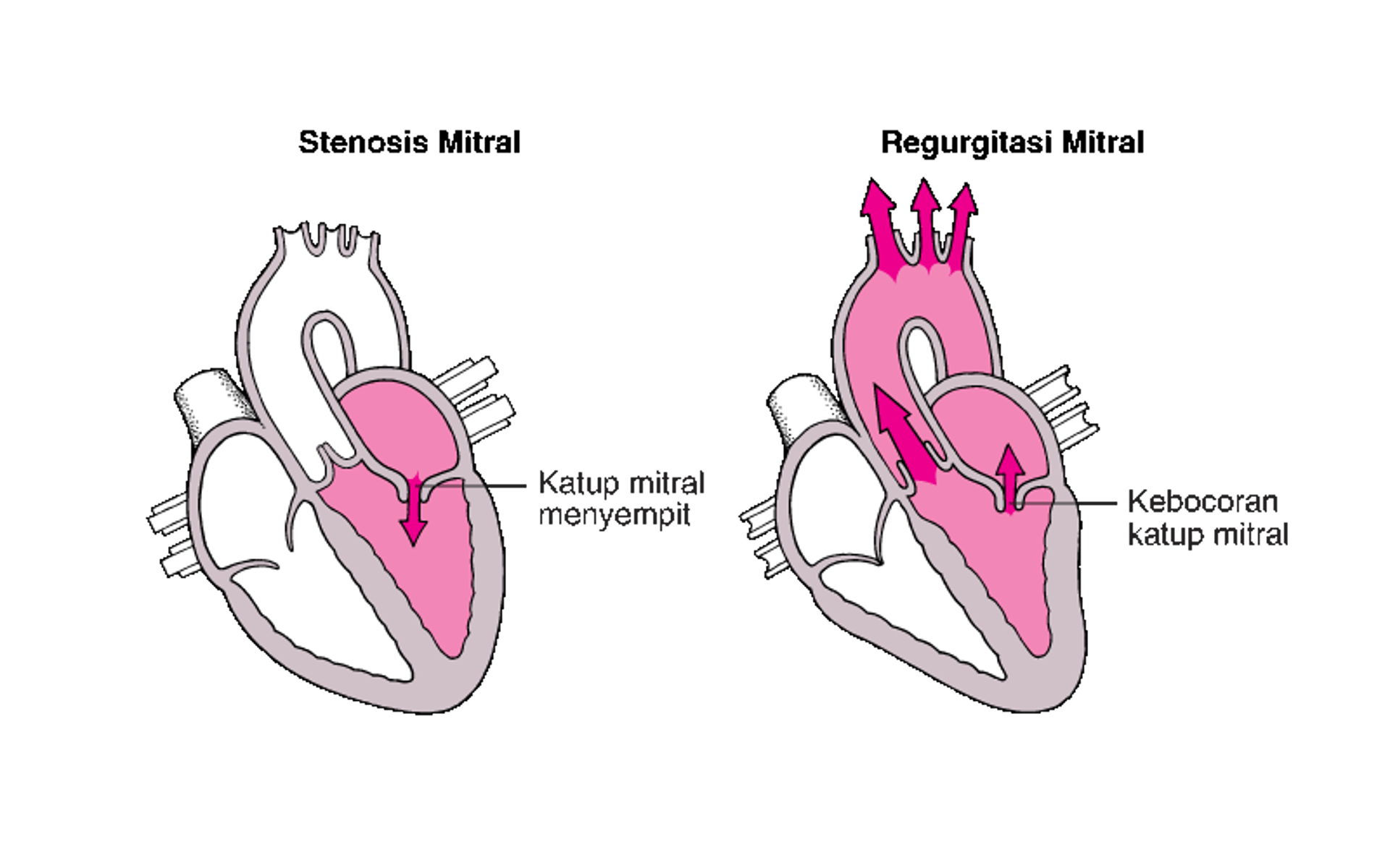 Memahami Stenosis dan Regurgitasi