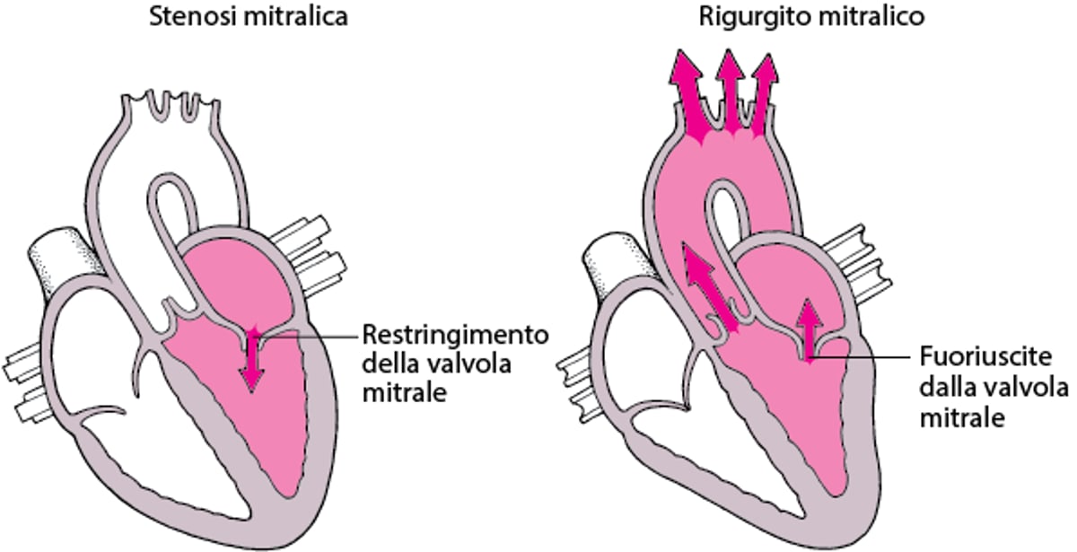 Capire la stenosi e l’insufficienza valvolare
