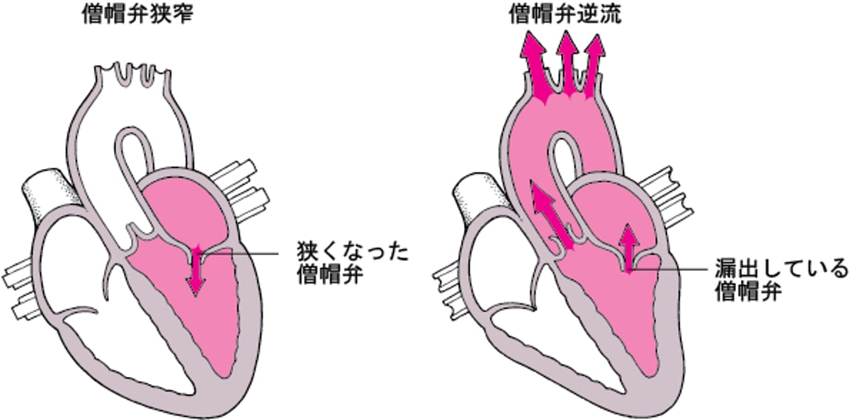弁の狭窄と逆流について