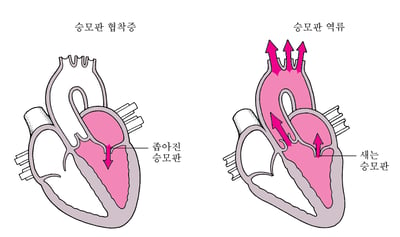 협착 및 역류란