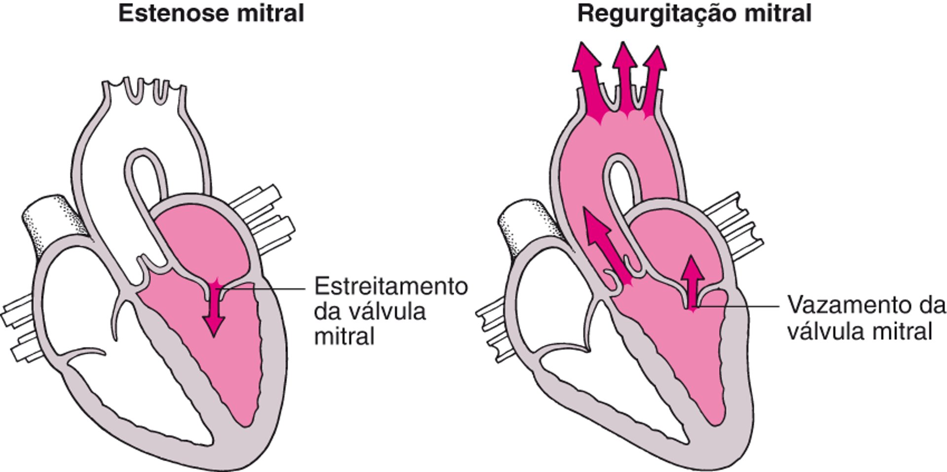 Compreender a estenose e a regurgitação