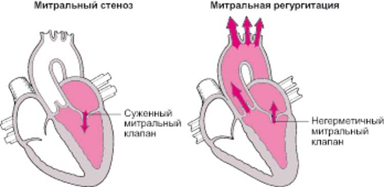 Объяснение стеноза и регургитации